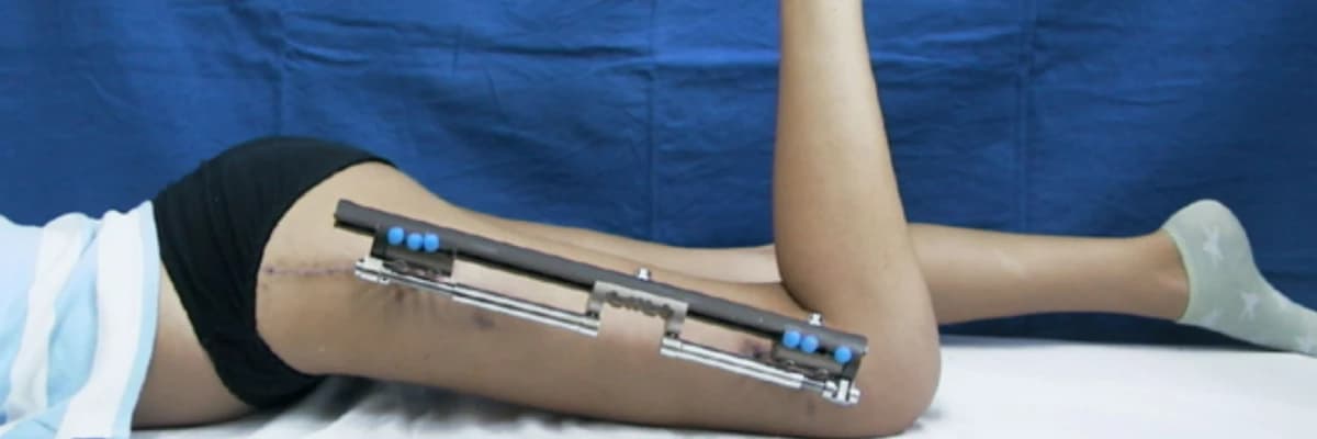 Boy uzatma ameliyatı nedir? Hangi teknikler kullanılır? Hangi Yöntem Daha Avantajlı? Kullanılacak yöntem nasıl belirlenir? Boy uzatma ameliyatı nasıl yapılır? İyileşme süreci ne kadar sürer?