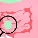 SIBO Nedir? Sürekli Şişkinliğin Gizli Nedeni Olabilir mi?