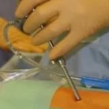 Bel Fıtığında Yeni Dönem: Endoskopik bel fıtığı ameliyatı