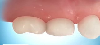 Progression of Decay (primary molars)