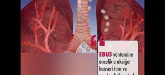 Endobronşiyal Ultrasonografi (EBUS) nedir? - Doç. Dr. İlim Irmak