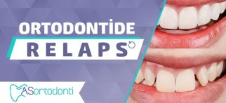 Ortodontide Relaps | AS Ortodonti
