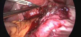 Laparoskopik Endometrioma cerrahisi